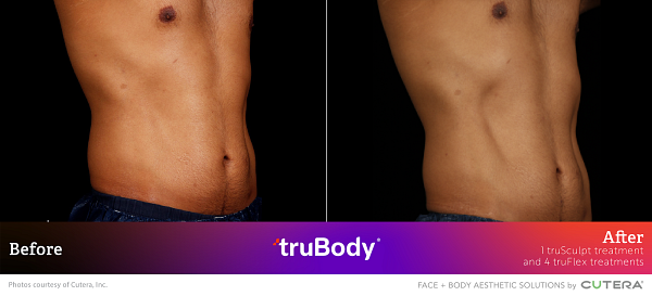 Before and after frontal view of truSculpt treatment results on male patient's abdomen provided by Cutera, Inc.