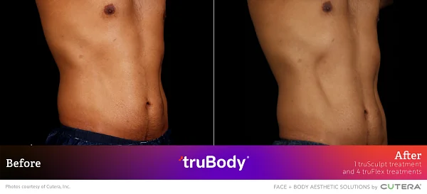 Before and after frontal view of truSculpt treatment results on male patient's abdomen provided by Cutera, Inc.