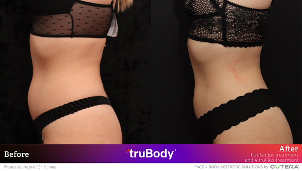 Before and after comparison of truSculpt impact on female waistline by Dr. Humes.