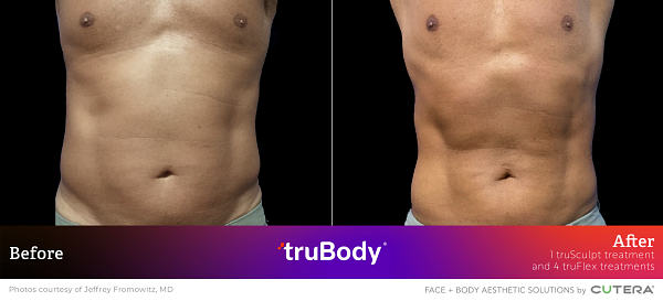 Before and after images of a male torso post-truSculpt treatment by Jeffrey Fromowitz, MD, demonstrating fat loss.