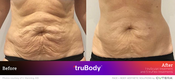 Before and after truSculpt treatment on a patient's abdomen by Dr. Manning showing skin tightening.