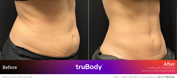Before and after photos of truSculpt's effects on female abdomen by Mira Kaga, MD.