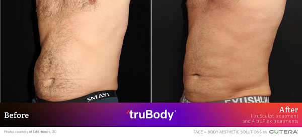 Before and after snapshot of truSculpt results on a male's flanks by Tahl Humes.
