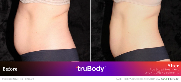 Before and after truSculpt treatment on female abdomen, showing a smoother contour post-treatment by Tahl Humes