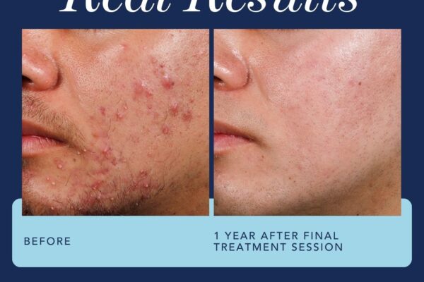 AviClear Before and After AviClear Before and After