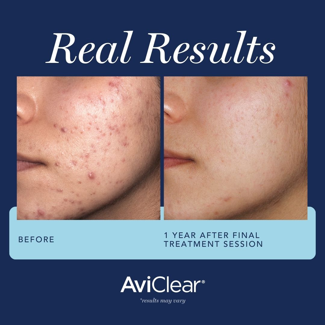 Before and after comparison of significant acne reduction treatment