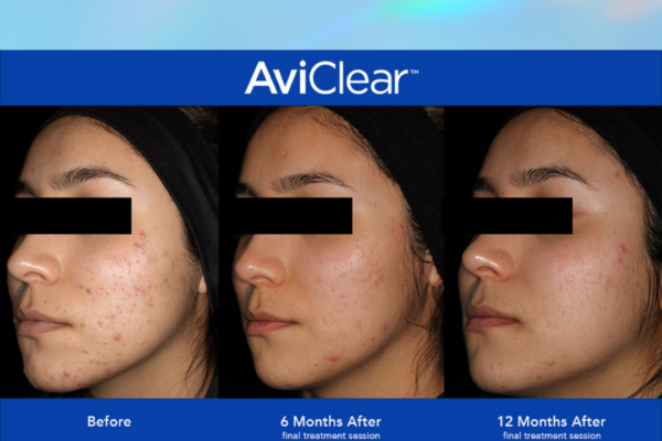 AviClear - the future of clear skin AviClear® Acne Treatment