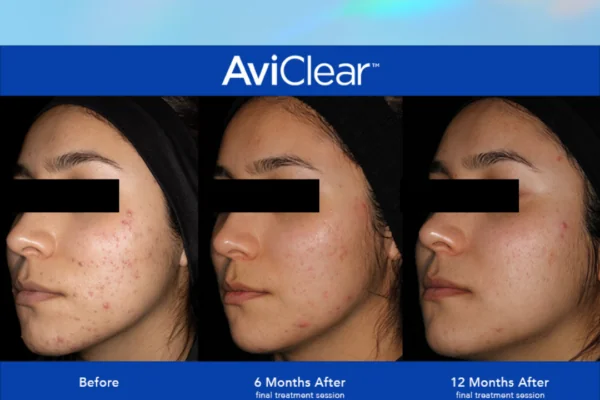 AviClear - the future of clear skin AviClear® Acne Treatment