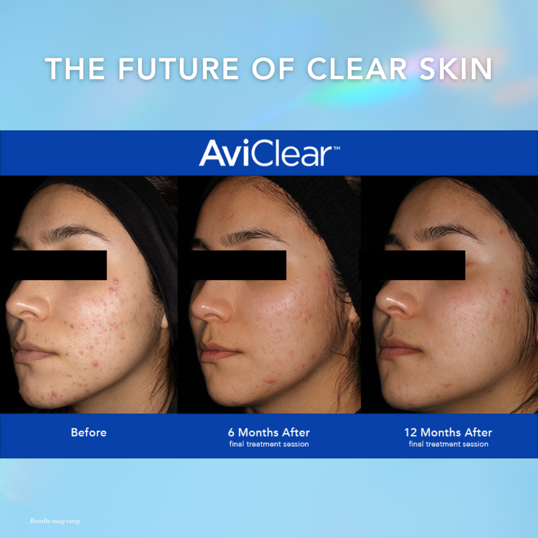 AviClear® Acne Treatment