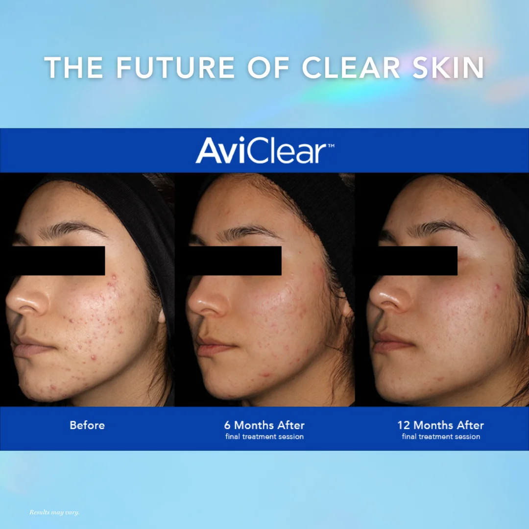 AviClear® Acne Treatment