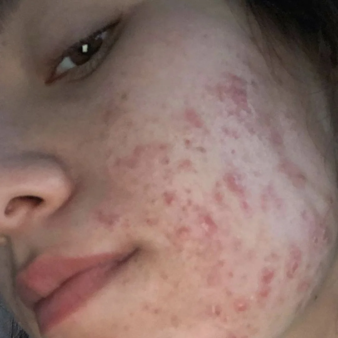 Close up of a girls face after 9 months during accutane treatment