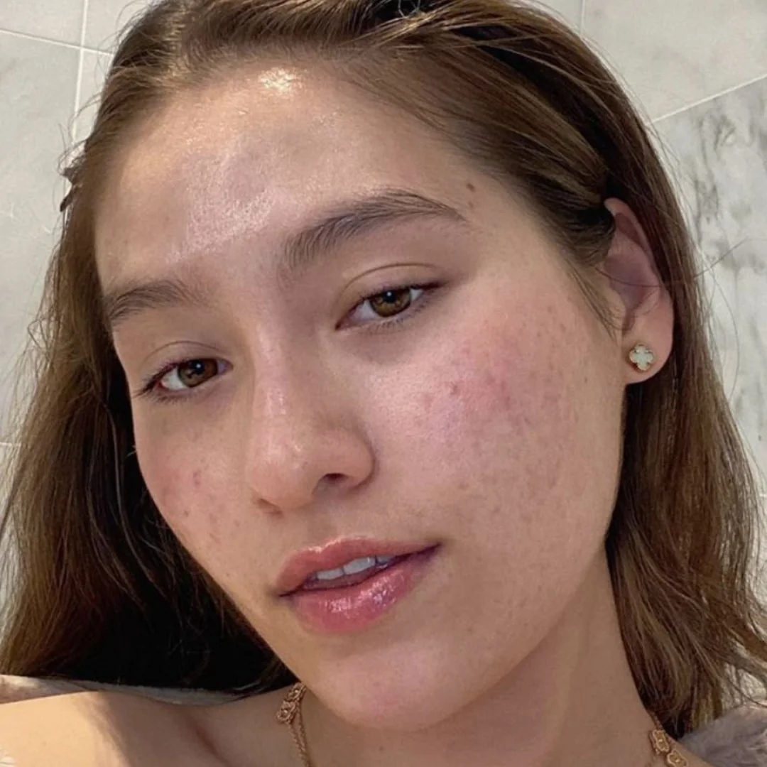 Effects of Accutane treatment after 9 months