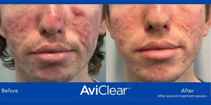 AviClear-B&A-Hobart-Acne-Treatment-1 AviClear-B&A-Hobart-Acne-Treatment-1