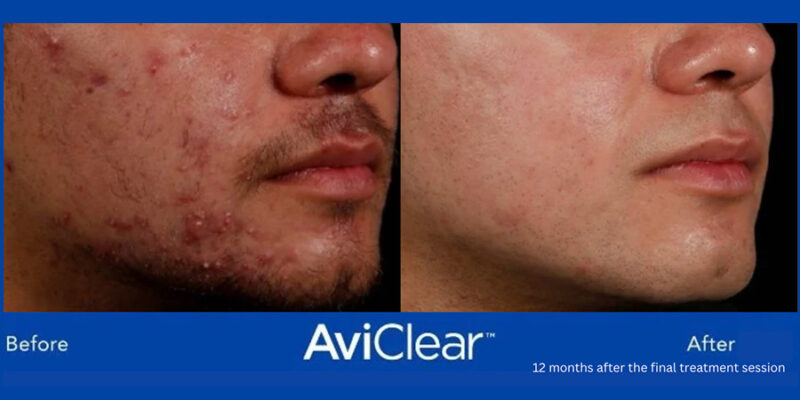 AviClear-B&A-Hobart-Acne-Treatment-2 AviClear-B&A-Hobart-Acne-Treatment-2