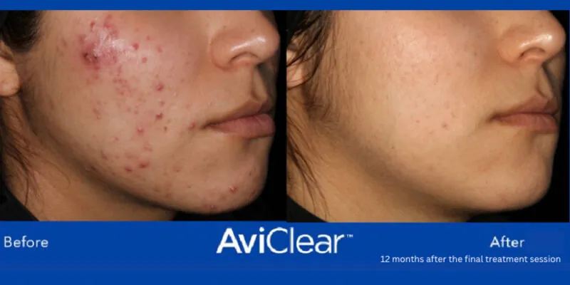 AviClear-B&A-Hobart-Acne-Treatment-3 AviClear-B&A-Hobart-Acne-Treatment-3