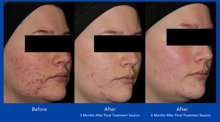 Avi Clear acne treatment before and after of a woman with sever acne