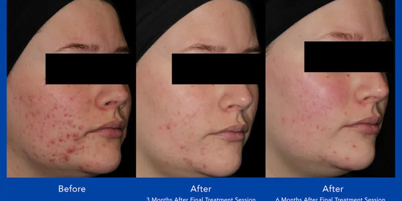 aviclear before and after in hobart Avi Clear acne treatment before and after of a woman with sever acne