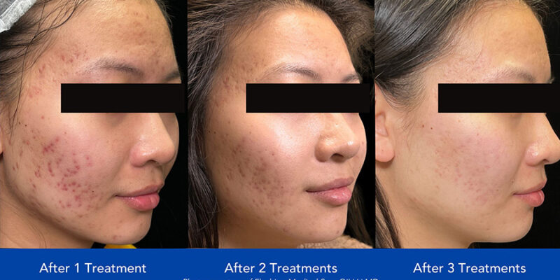 AviClear-B&A-Hobart-Acne-Treatment-5 AviClear-B&A-Hobart-Acne-Treatment-5