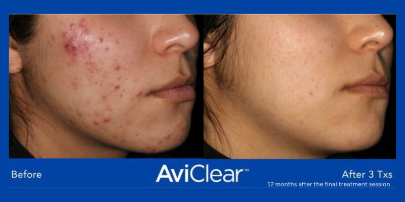 AviClear-B&A-Hobart-Acne-Treatment AviClear-B&A-Hobart-Acne-Treatment