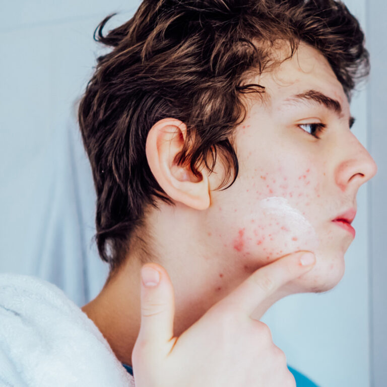 "Close-up of a face with visible acne, highlighting skin texture and blemishes"