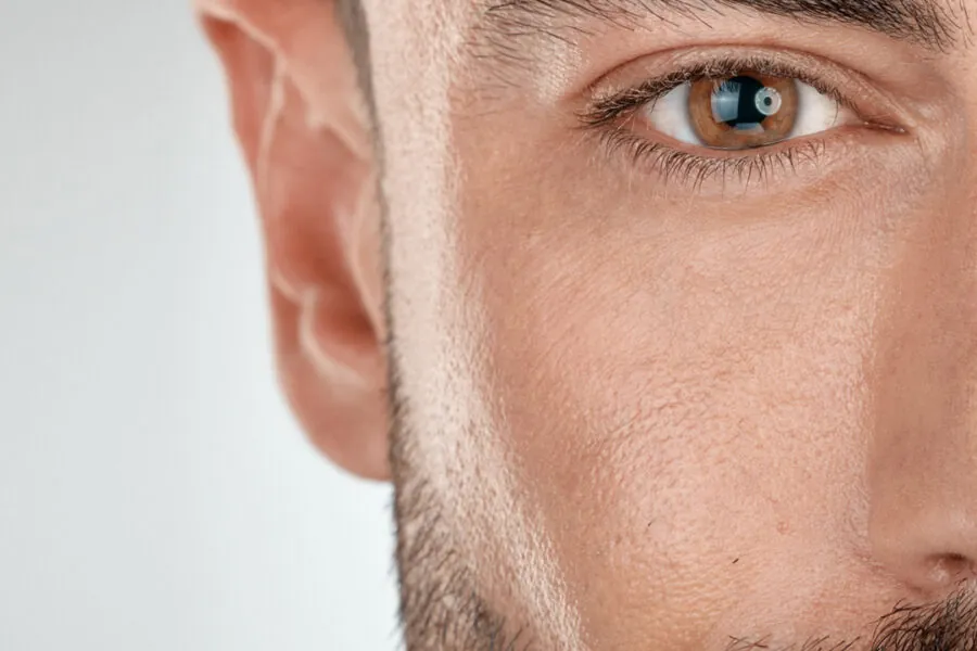 Close-up face with no visible acne, showcasing skin concerns in need of treatment.