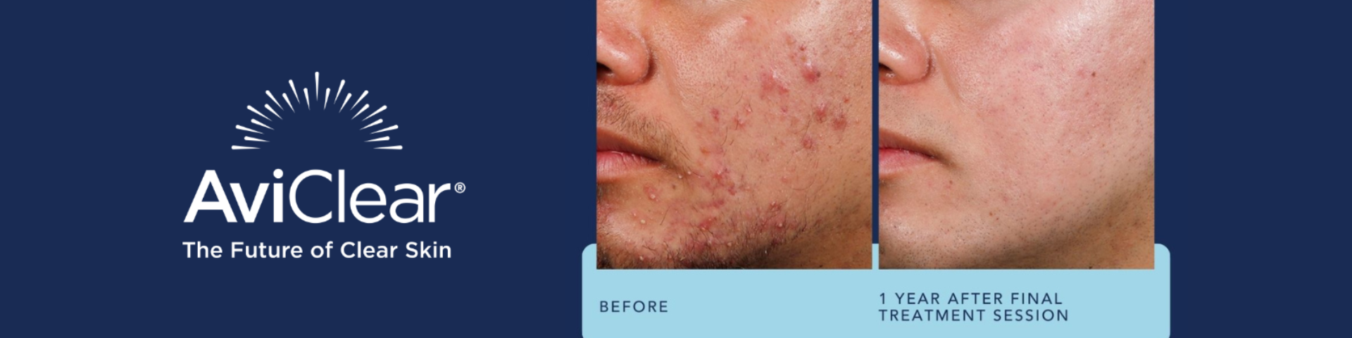 Avi Clear acne treatment before and after of a man with sever acne