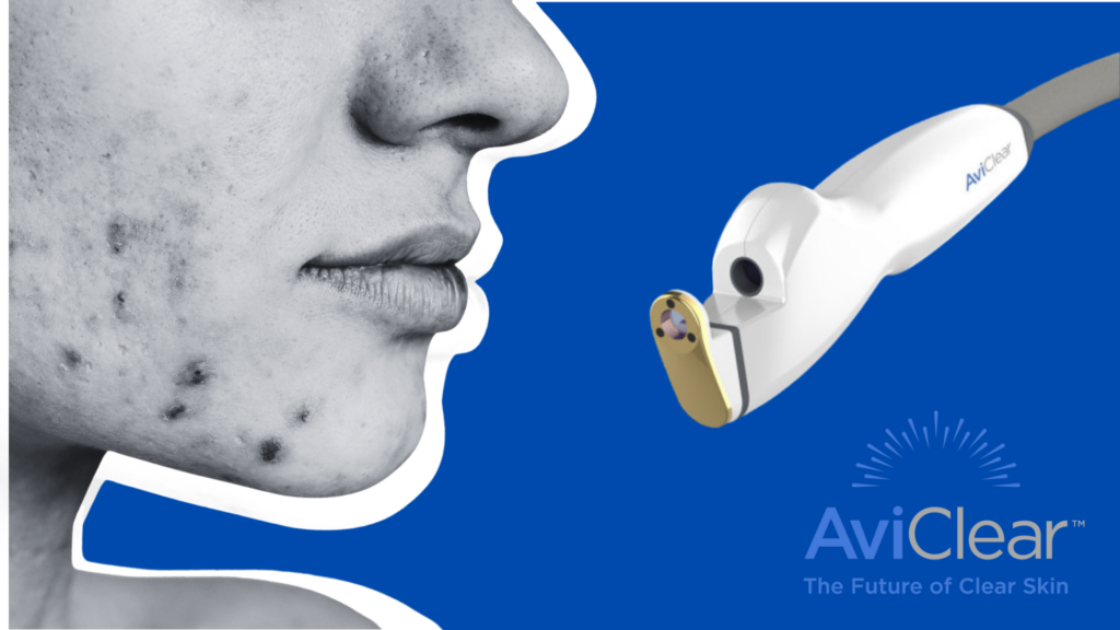 AviClear laser treatment at Sharkra Medi Spa